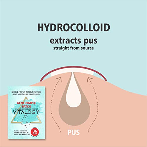 Acne Pimple Patch | Advanced Hydrocolloid Acne Patches Formula - Pimple Patches for Face | OVERNIGHT Treatment - 36 Dot Patches (2 Sizes)