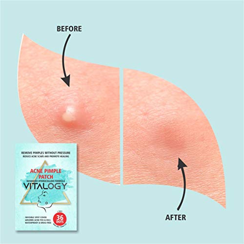 Acne Pimple Patch | Advanced Hydrocolloid Acne Patches Formula - Pimple Patches for Face | OVERNIGHT Treatment - 36 Dot Patches (2 Sizes)
