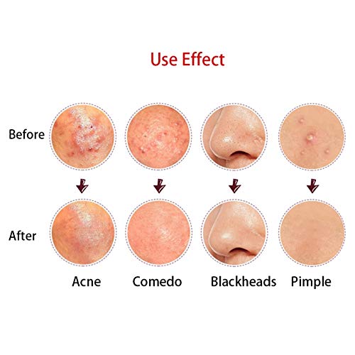 Blackhead Remover Tool Kit - 4 in 1 Acne and Pimple Removal Tool - Nose & Face Blackheads Remover - ROSE GOLD